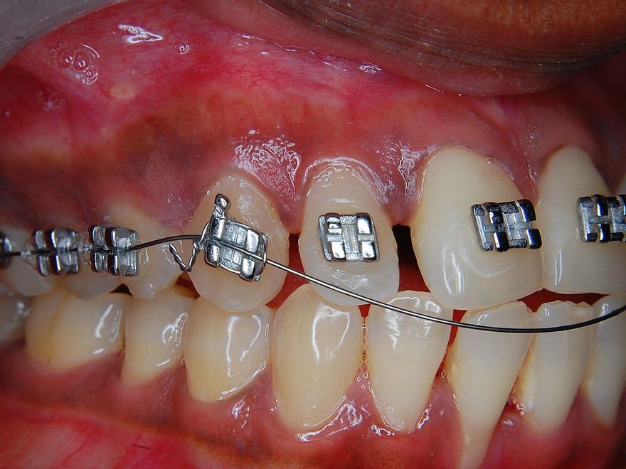 Close-up of teeth with metal orthodontic braces