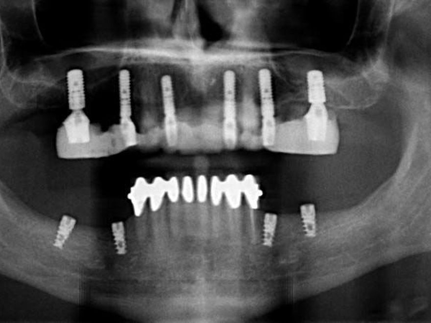 Panoramic X-ray showing dental implants in the upper and lower jaw