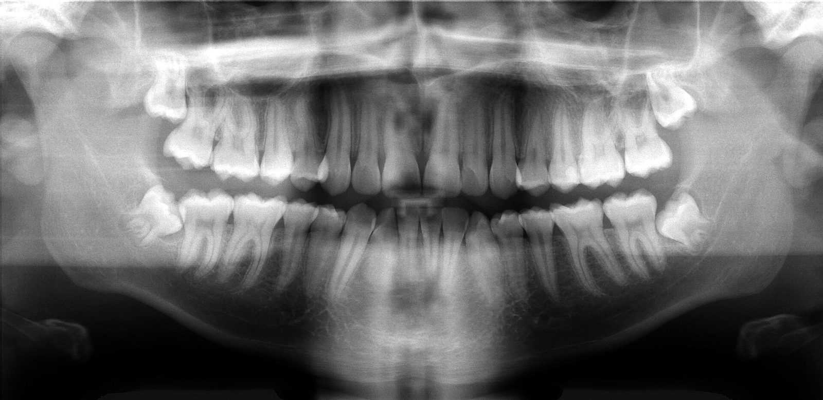 Panoramic dental X-ray (OPG) showing the upper and lower teeth and jaws