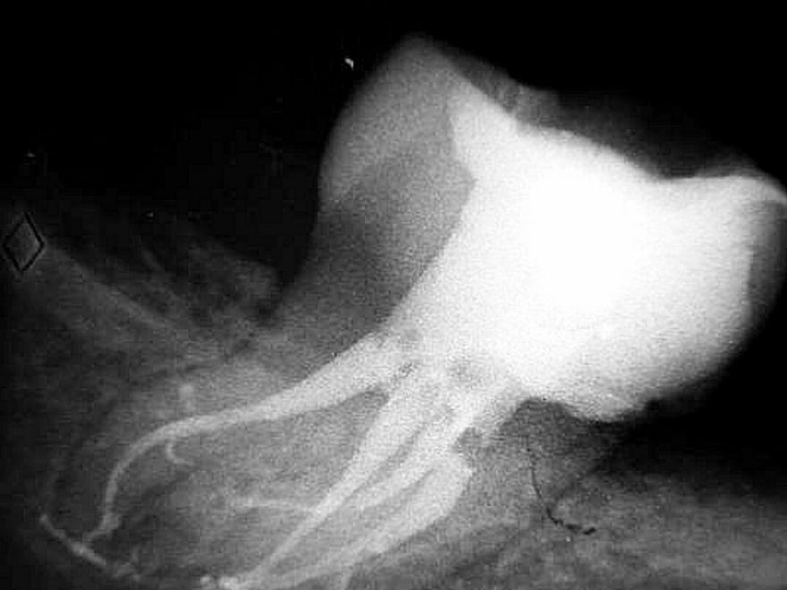 X-ray of a molar after root canal treatment, the filled canals showing white