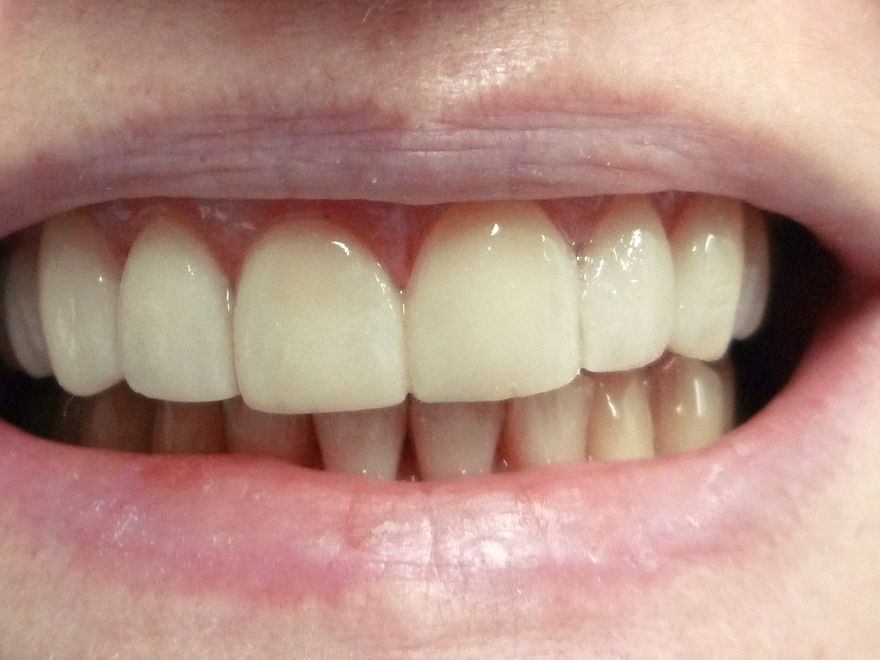 A close-up of an even, bright smile