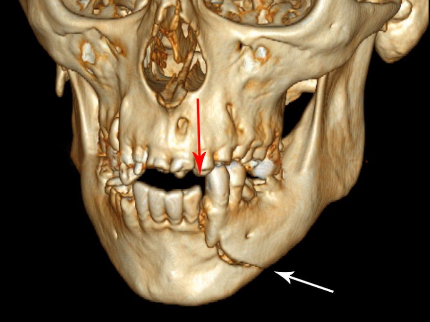 3D CT scan of a skull showing a fractured lower jaw, marked with arrows
